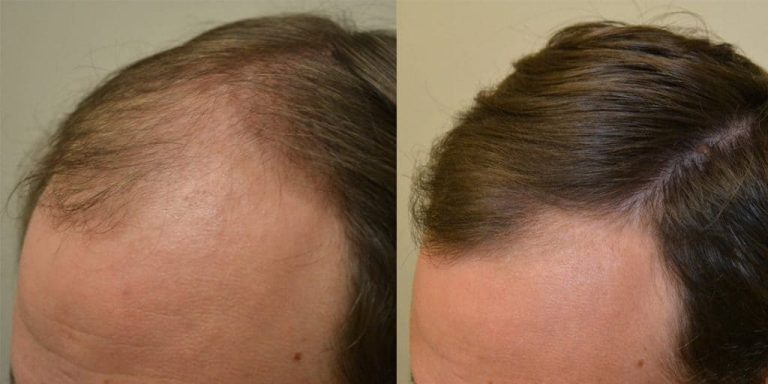 Avail pros of hair transplant and tummy tuck surgeries Avail pros of hair transplant and tummy tuck surgeries