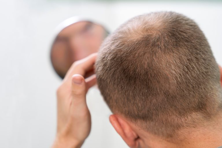 Battling Hair Loss:   Hair loss treatment